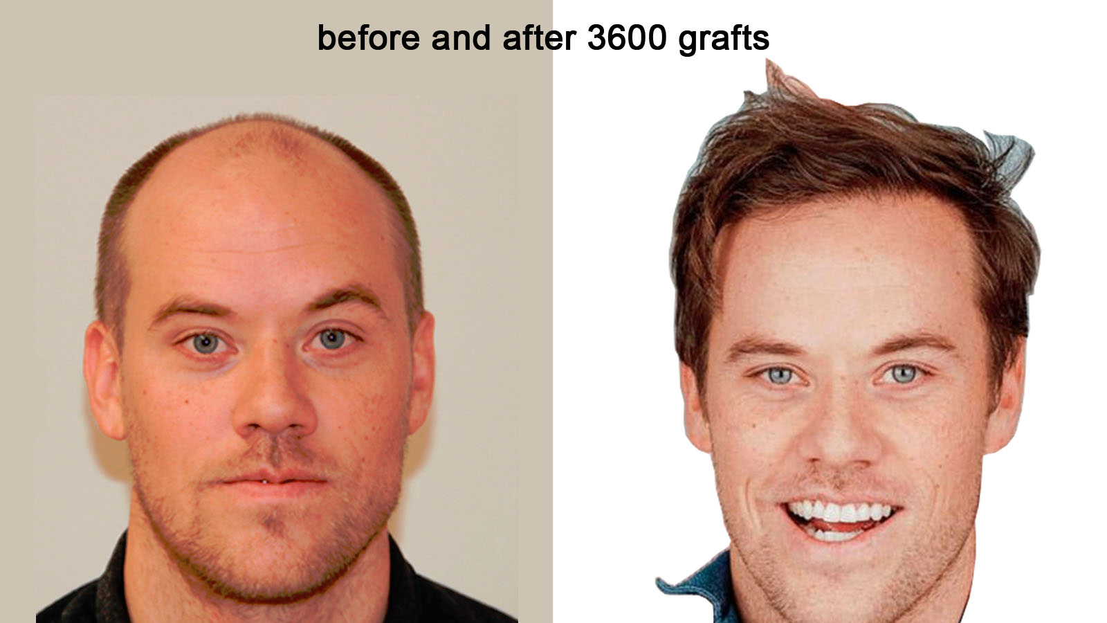 You are currently viewing Best Hair Transplantation in Scottsdale Arizona at Physicians Hair Institute