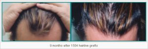 Read more about the article Are you a Candidate for Hair Transplant Surgery in Scottsdale at Physicians Hair Institute