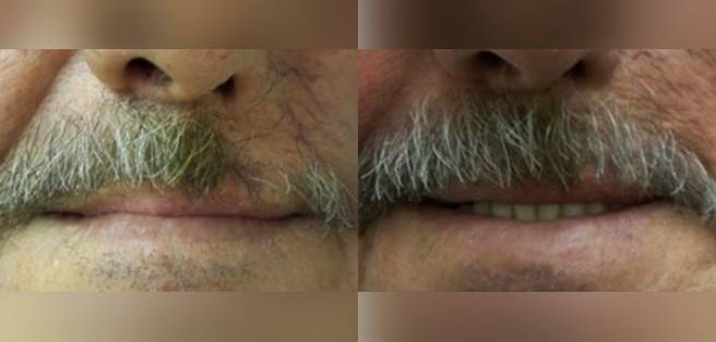Read more about the article Patient 1 Mustache