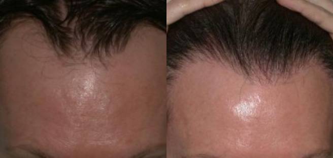 Read more about the article Patient 11 Grafts