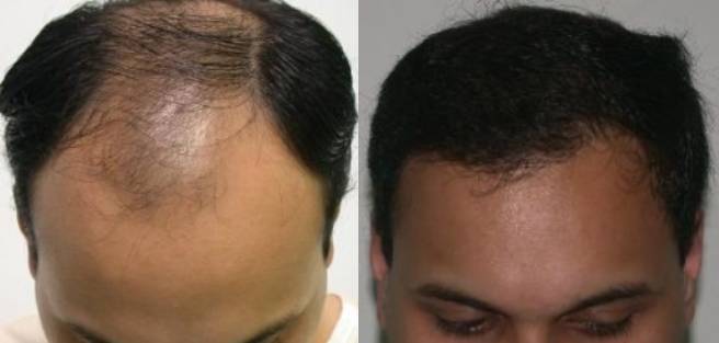 Read more about the article Patient 18 Grafts