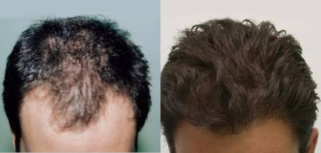 Read more about the article Patient 19 Grafts