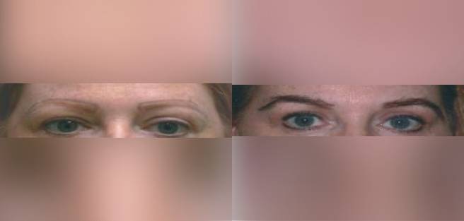 Read more about the article Patient 1 Eyebrow