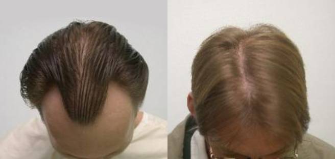 Read more about the article Patient 20 Grafts