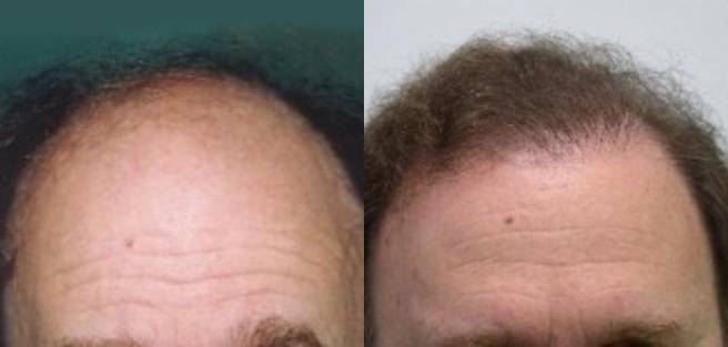 Read more about the article Patient 22 Grafts
