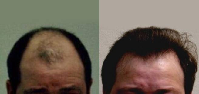 Read more about the article Patient 23 Grafts