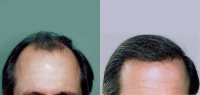 Read more about the article Patient 24 Grafts