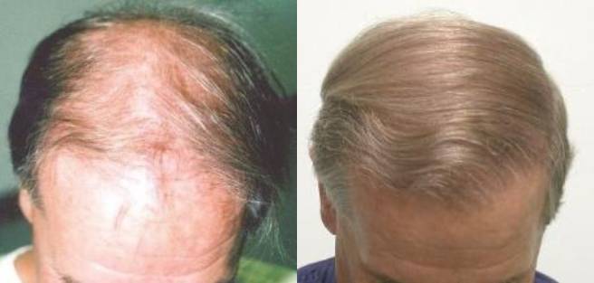 Read more about the article Patient 26 Grafts