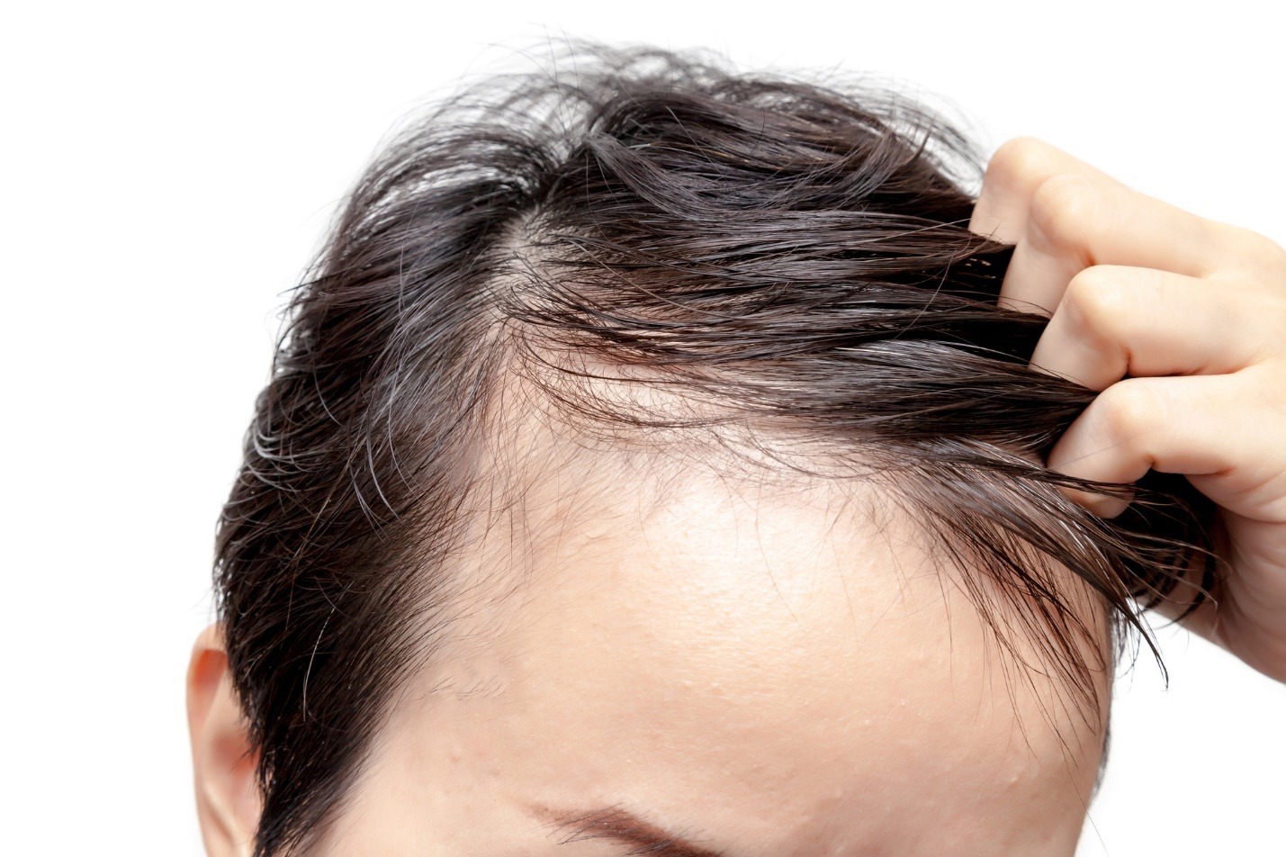 Read more about the article Comparing Scalp Micropigmentation Costs: Is It Worth the Investment for Hair Loss Solutions?