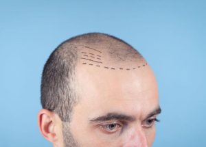 Read more about the article FUT and FUE Hair Restoration Arizona: Which One Is Best for You?