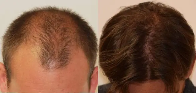 You are currently viewing Hair Transplant in Tucson with FUE’s for Natural, Permanent Hair