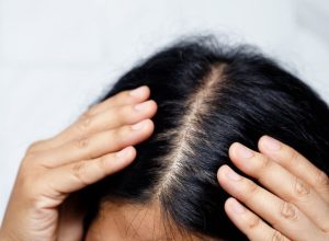 Read more about the article 3 Best Non-Surgical Hair Loss Treatments for Women | Tucson and Scottsdale, AZ