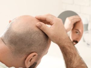Read more about the article Which Vitamin Deficiency Causes Hair Loss?