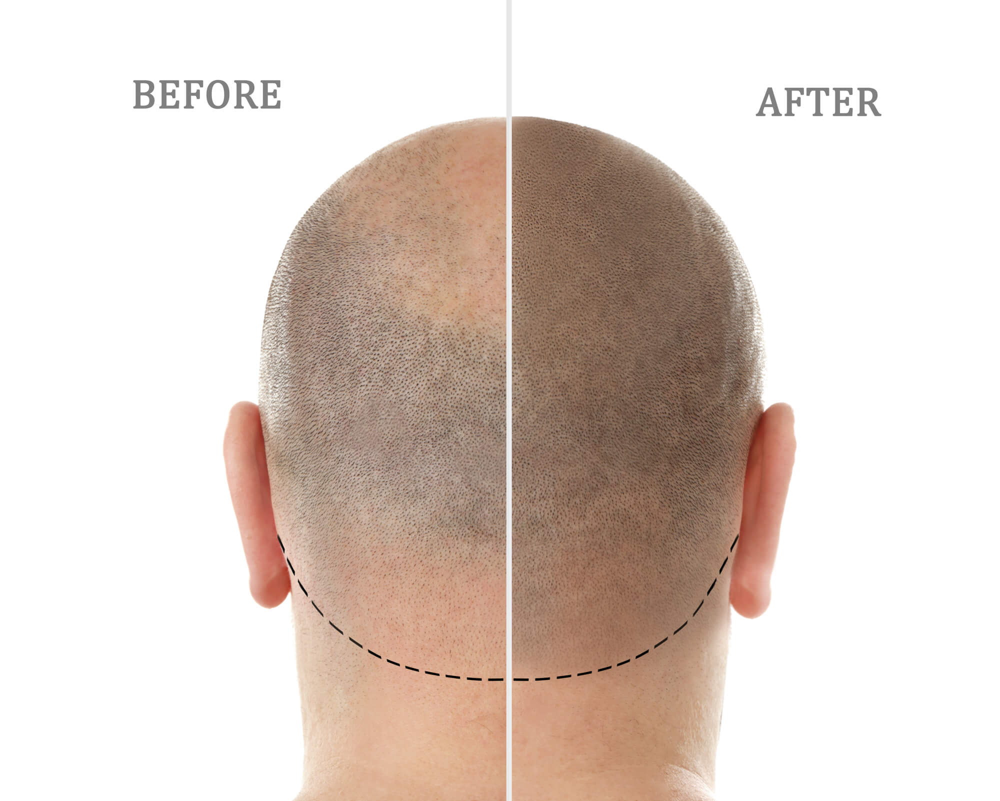 You are currently viewing Thinning Hair? How Scalp Micropigmentation Can Recreate the Hairline You Desire
