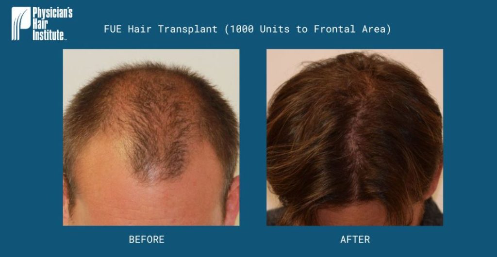 Before and after images of a FUE (Follicular Unit Extraction) hair transplant procedure, showcasing a 1000-unit transplant to the frontal area. The left image illustrates significant hair thinning and loss, while the right image displays a fuller, healthier hairline post-procedure. These results highlight the effectiveness of FUE in restoring hair density and improving overall appearance. Ideal for individuals considering hair restoration options, these images serve as a visual reference for potential outcomes of hair transplant treatments.