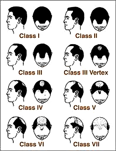 hair loss pattern