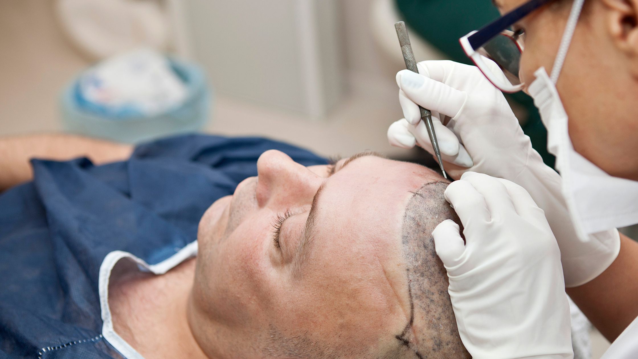 do you have to shave your head for a fut hair transplant featured image