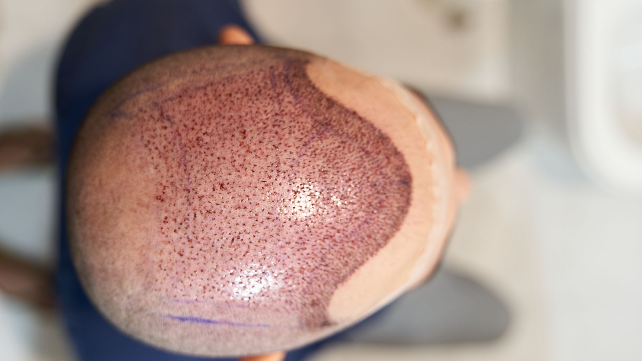 does fut get more grafts featured image