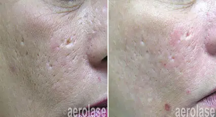 acne scars.webp