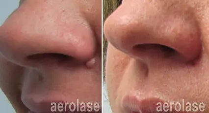 lesion3 pair.webp