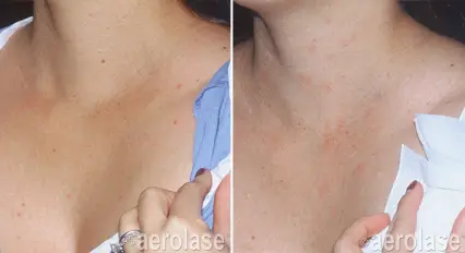 lesions2 pair.webp