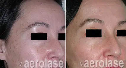 micropeel1 pair.webp