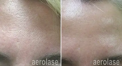 micropeel2 pair.webp