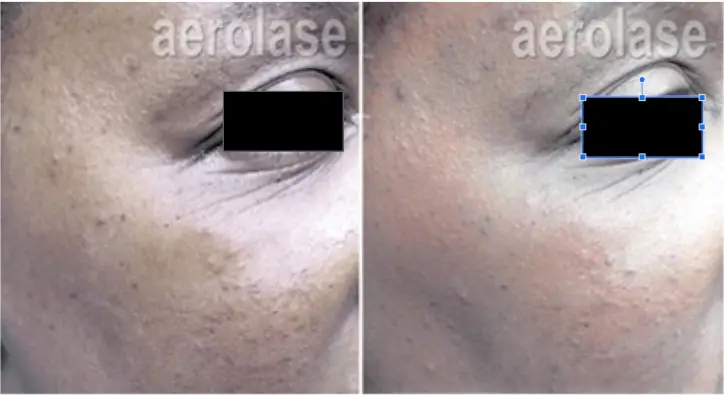 micropeel3 pair.webp