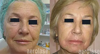 skin resurfacing renew3.webp