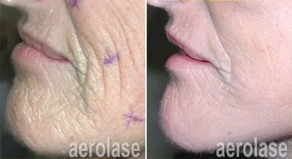 skin resurfacing renew5.webp