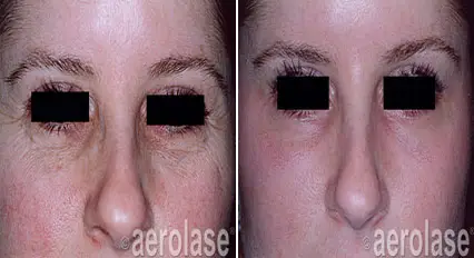 sun damage1 pair.webp