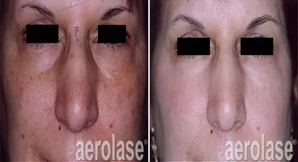 sun damage2 pair.webp