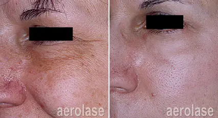 sun damage3 pair.webp